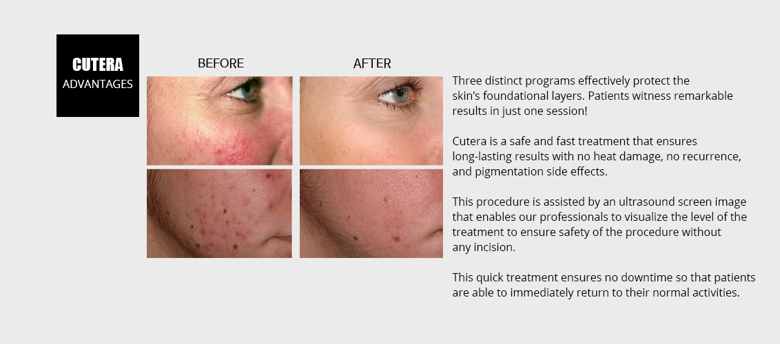 Three distinct programs effectively 
				protect the skin's foundational layers.
				Patients witness remarkable results
				in just one session!