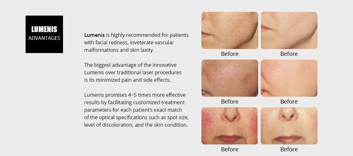 Lumenis is highly recommended for patients
				with facial redness, inveterate vascular
				malformations and skin laxity.