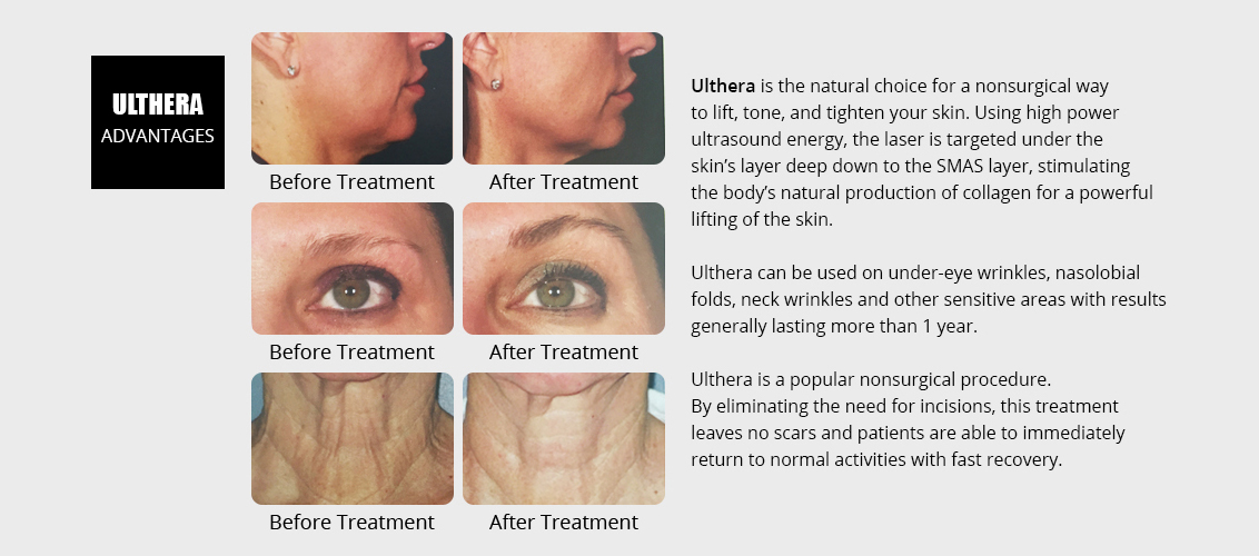 Ulthera is the natural choice for a nonsurgical
					way to lift, tone, and tighten your skin. Using 
					high power ultrasound energy, the laser is 
					targeted under the skin's layer deep 
					down to the SMAS layer, stimulating the body's 
					natural production of collagen for a powerful 
					lifting of the skin.