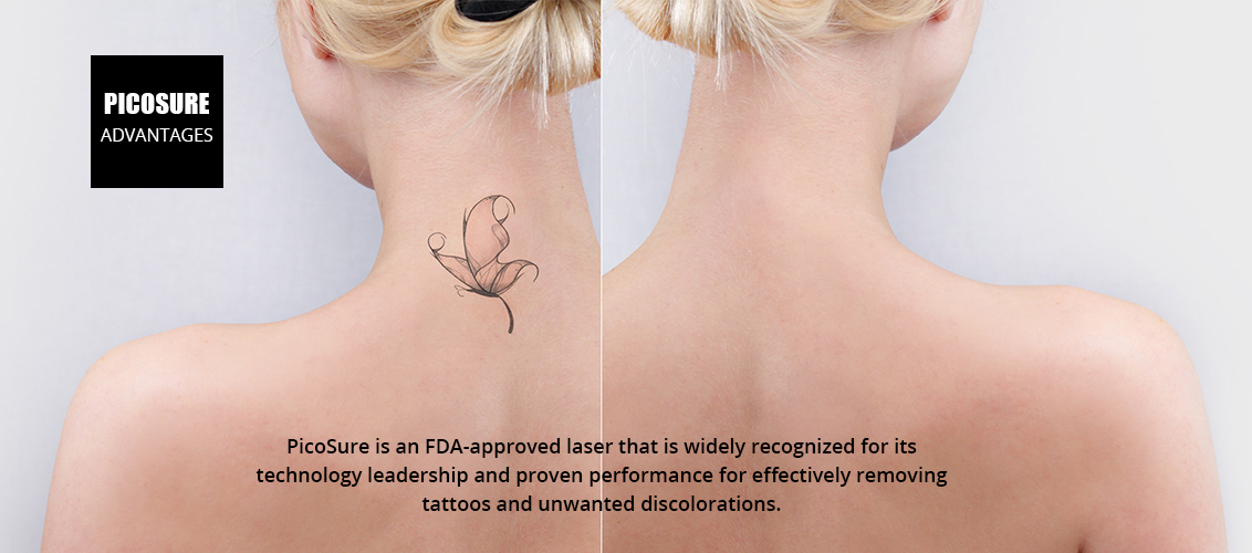 PicoSure is an FDA-approved laser that is widely recognized for its
				technology leadership and proven performance for effectively removing
				tattoos and unwanted discolorations.